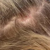 Nahaufnahme der Kopfhaut mit fettigen Schuppen und Rötungen. Die Haare sind hellbraun und durchzogen von feinen Schuppen.