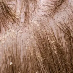 Nahaufnahme der Kopfhaut mit extremen Schuppen, die sich zwischen den braunen Haaren abzeichnen.