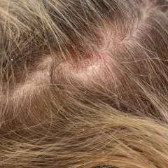 Nahaufnahme der Kopfhaut mit fettigen Schuppen und Rötungen. Die Haare sind hellbraun und durchzogen von feinen Schuppen.
