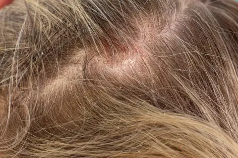 Nahaufnahme der Kopfhaut mit fettigen Schuppen und Rötungen. Die Haare sind hellbraun und durchzogen von feinen Schuppen.