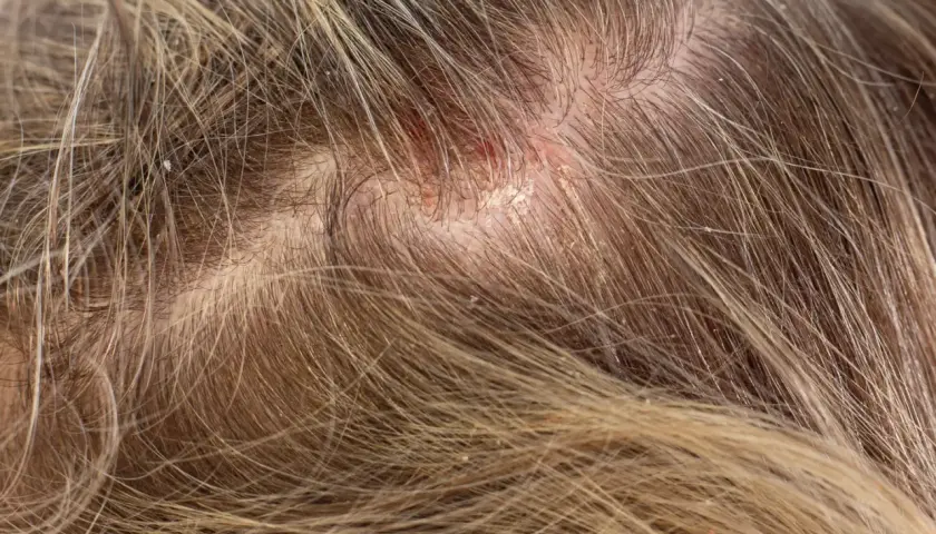 Nahaufnahme der Kopfhaut mit fettigen Schuppen und Rötungen. Die Haare sind hellbraun und durchzogen von feinen Schuppen.