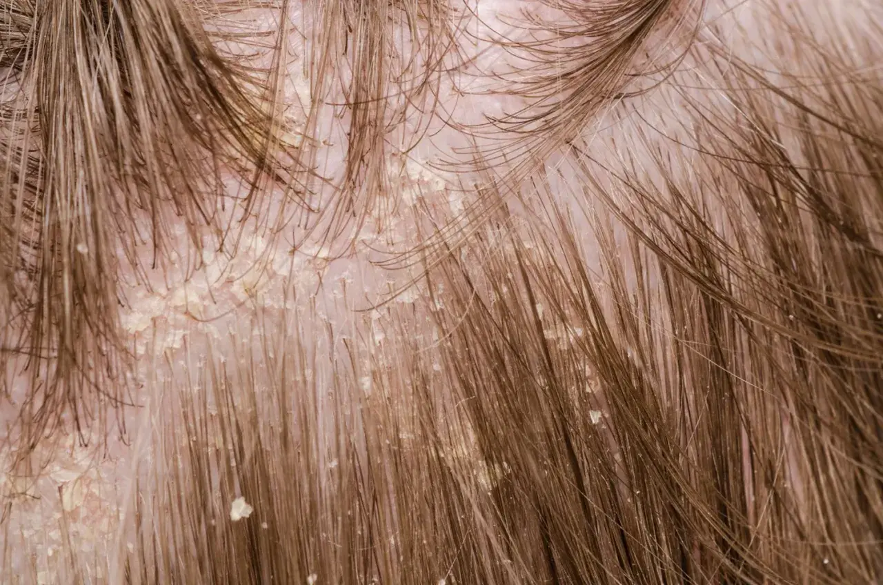Nahaufnahme der Kopfhaut mit extremen Schuppen, die sich zwischen den braunen Haaren abzeichnen.