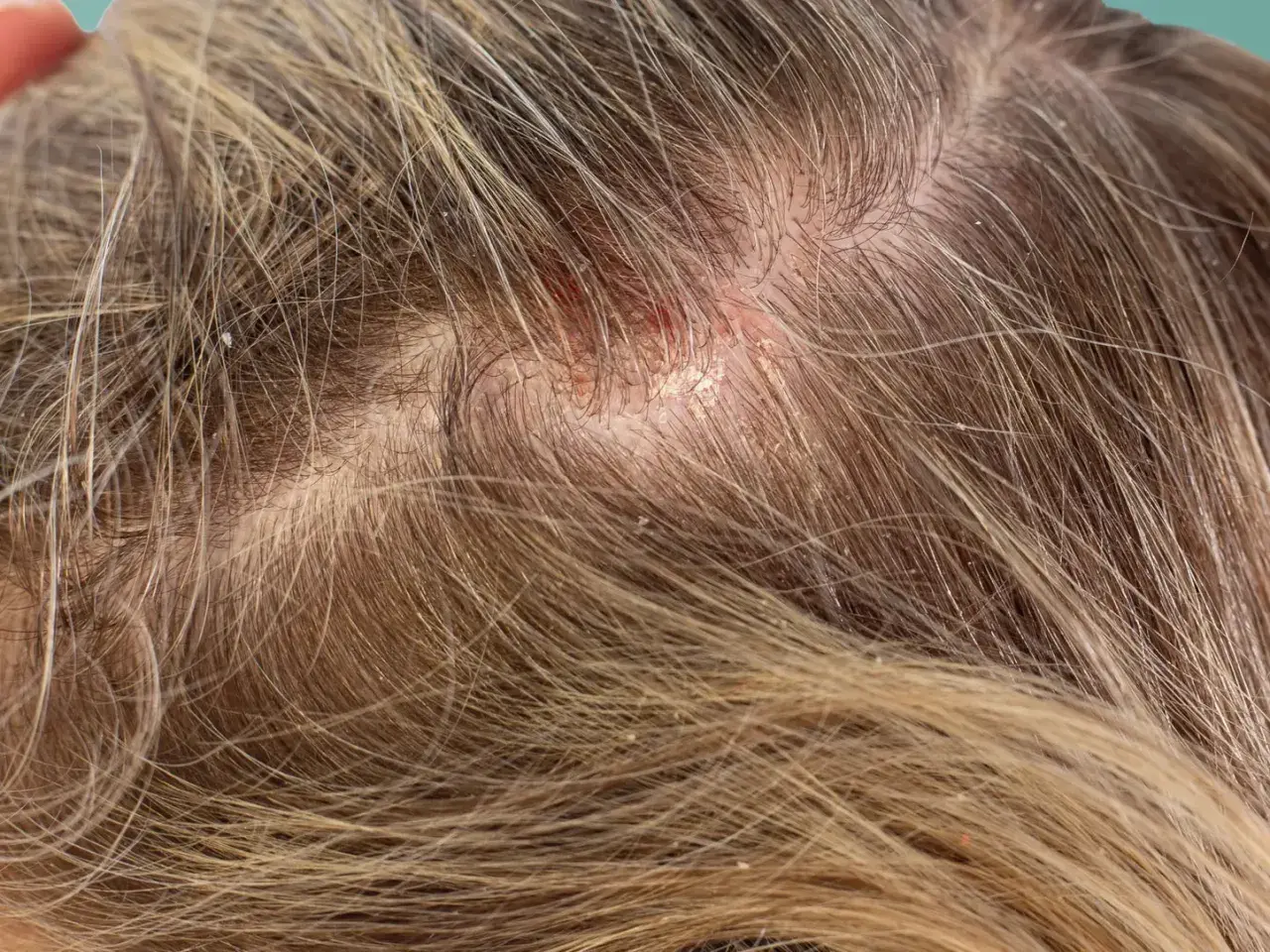 Nahaufnahme der Kopfhaut mit fettigen Schuppen und Rötungen. Die Haare sind hellbraun und durchzogen von feinen Schuppen.