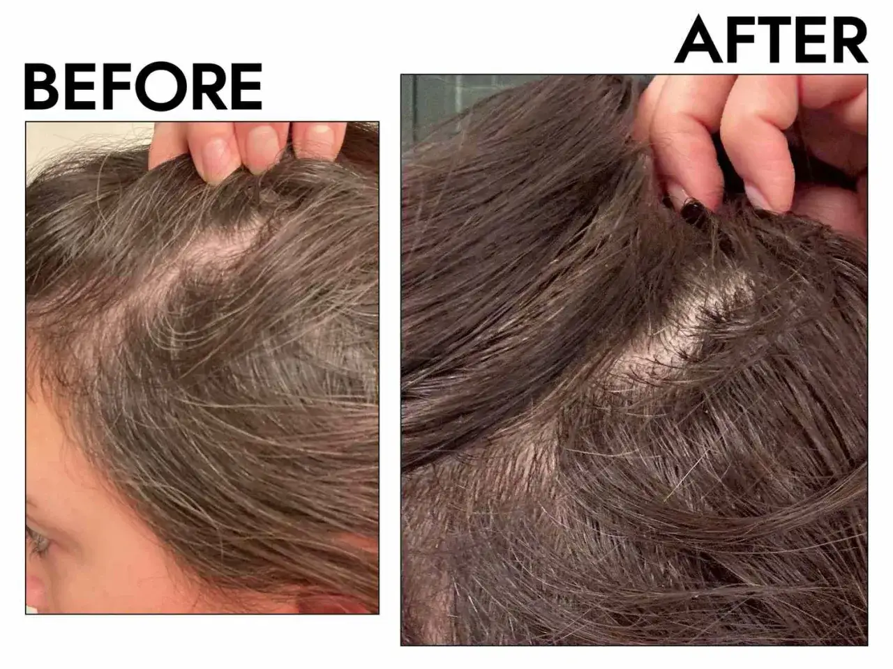 Vorher/Nachher-Vergleich: Deutlich dichteres Haar nach Anwendung von Aminexil vs. Minoxidil.